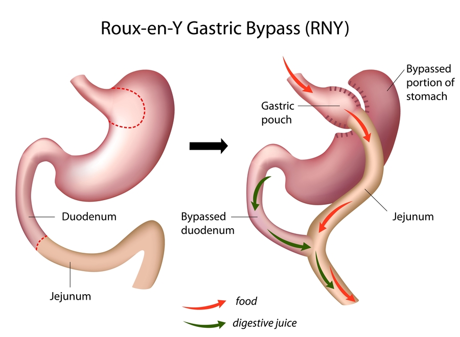 Laparoscopische Gastric Bypass Dokter Fernando Sirbu